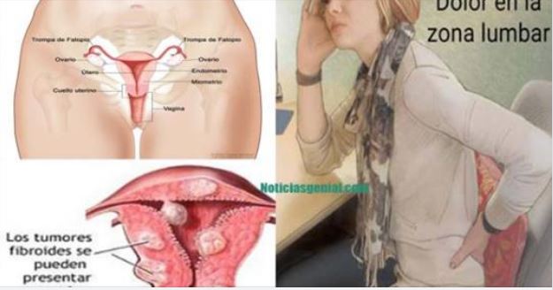 Remedio natural para los ovarios, eliminar quites y limpiar el útero