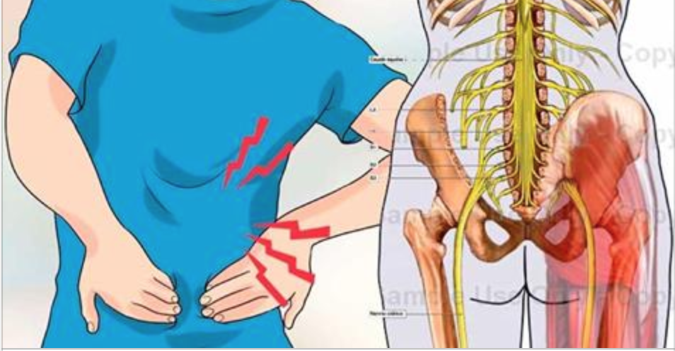 Como desbloquear el nervio ciático para eliminar el dolor